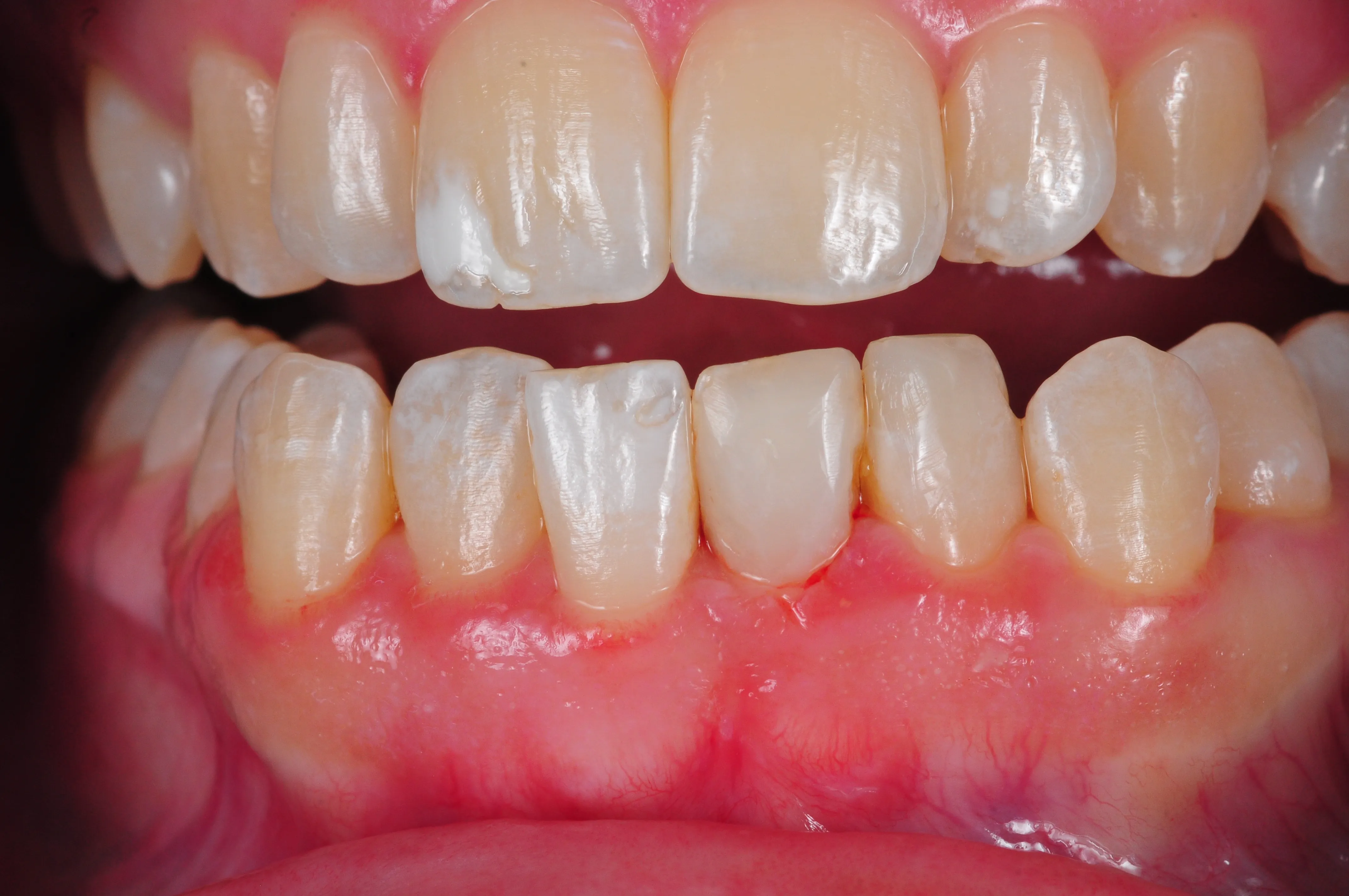 Después - Reconstrucción estética