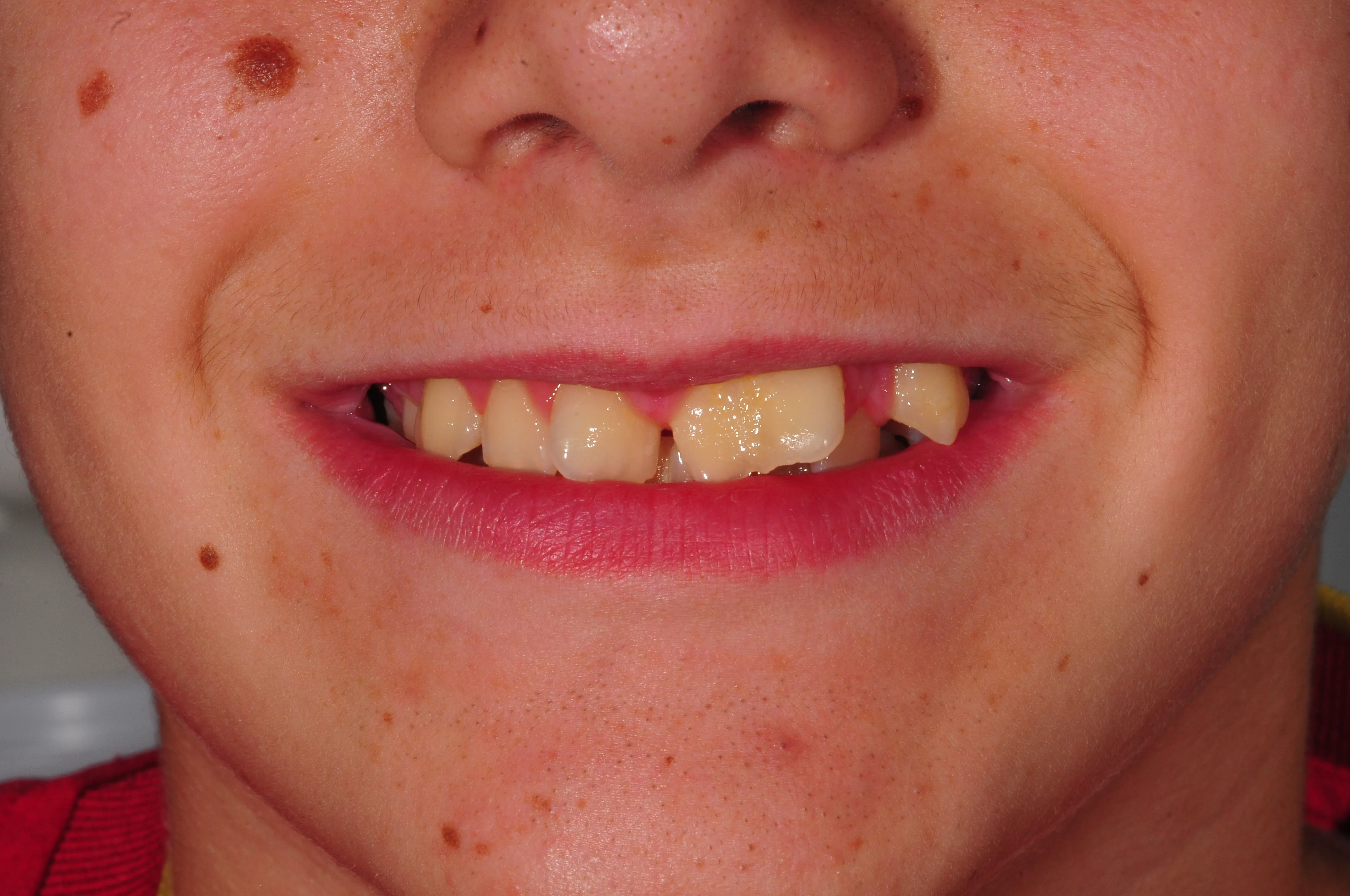 Antes - Caso complejo rehabilitación oral