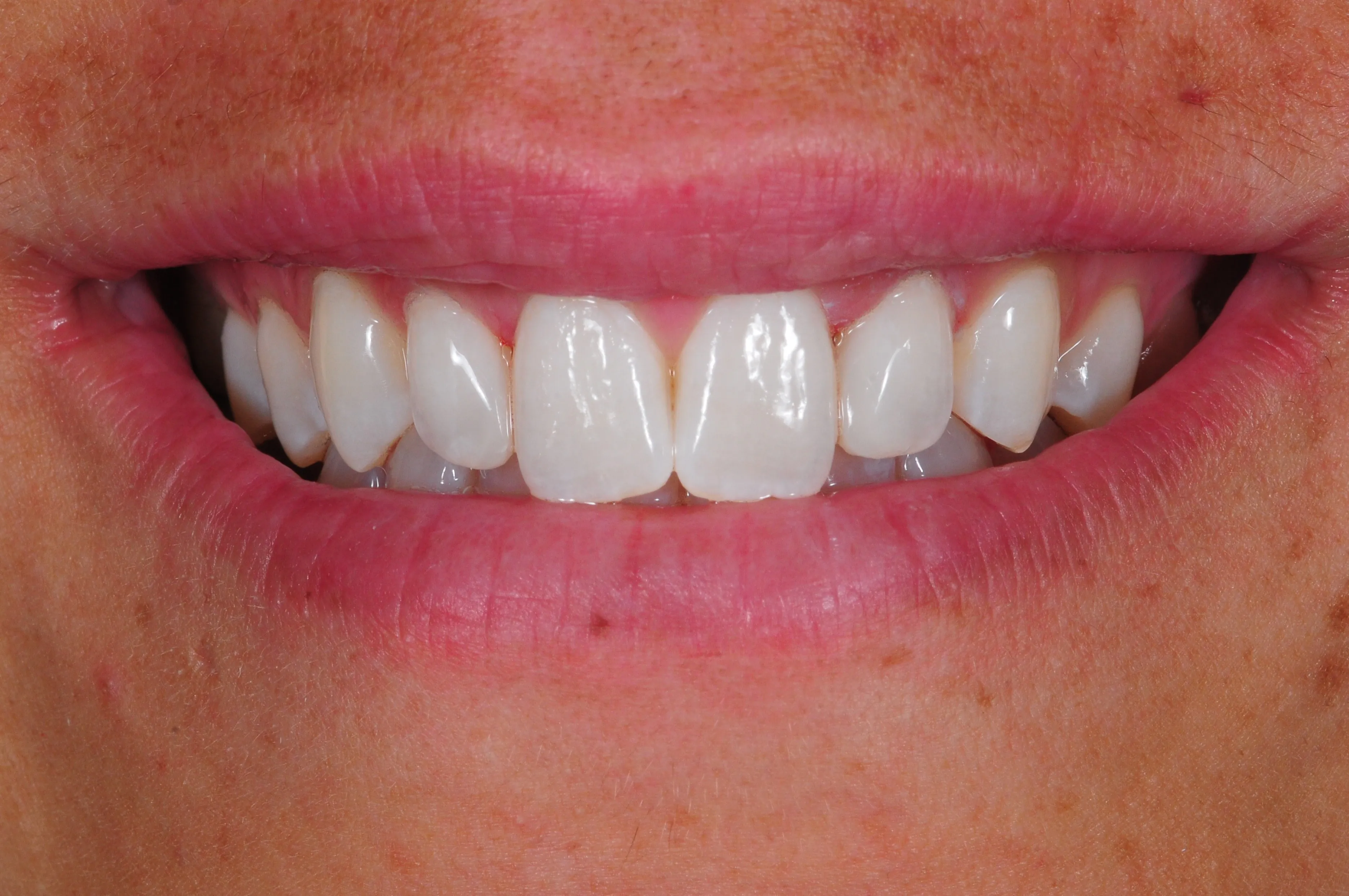 Después - Cierre de diastema