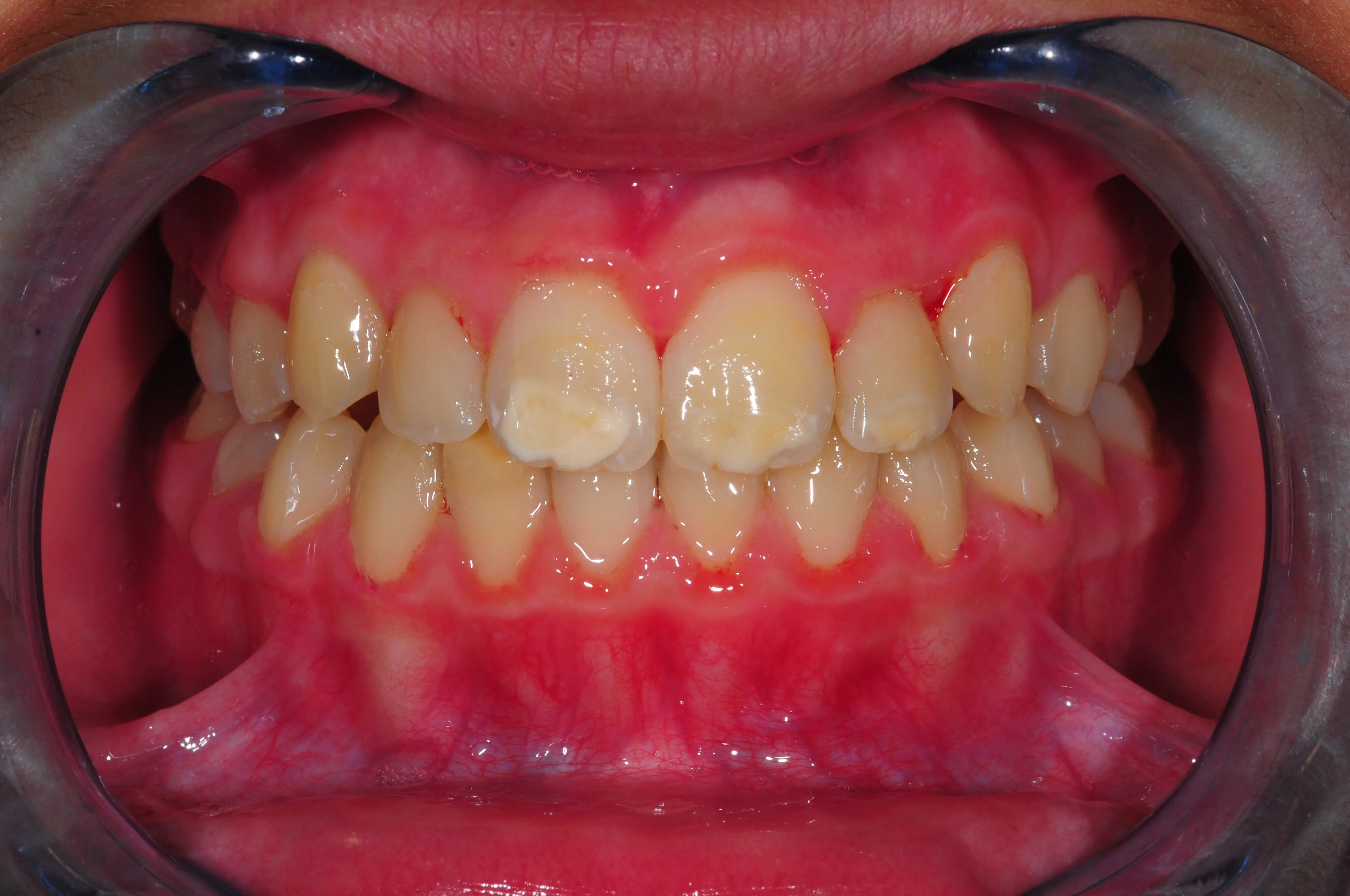 Después - Alineadores SPARK