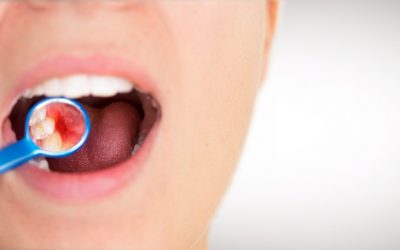 Gingivitis: glosario del dentista (4)