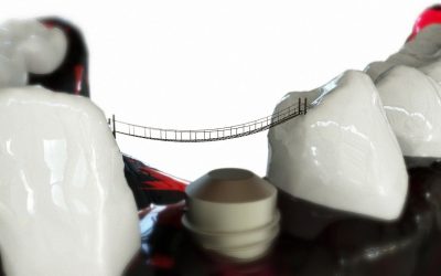 Implantes: Glosario del dentista (V)